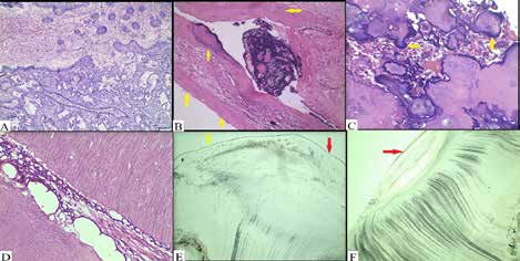 . Histopathological findings: A. Odontogenic epithelium showing proliferation of
epithelial lining in the form of interconnecting cords and strands, follicles and
islands into stromal tissue.(10X)
B. Tumor tissue with extensive dentinoid material (yellow arrow) is appreciated in
juxtaepithelial region.(10X)
C. Numerous ghost cells undergoing calcification (yellow arrow).(40X)
D. Tubular dentin with pulp like area. (40X)
E and F. Ground sections showing bulk of tubular dentin covered with cementum at one
end (yellow arrow) and discontinuous enamel at the other end (red arrow). (10X)