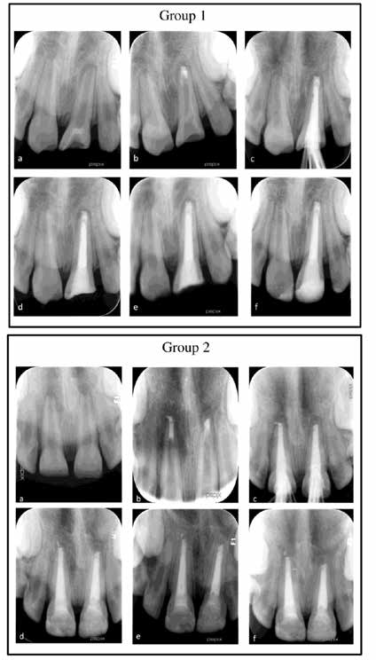 . Examples of the radiographs taken during the treatment protocols and
follow-up procedure in each group. (a) Initial, (b) apical plug with MTA,
(c) immediate post-treatment, (d) 3, (e) 6, and (f) 12 months follow-up.