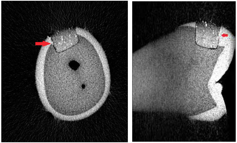. Cross and axial sections showing dye penetration to half of interface length-Score 1