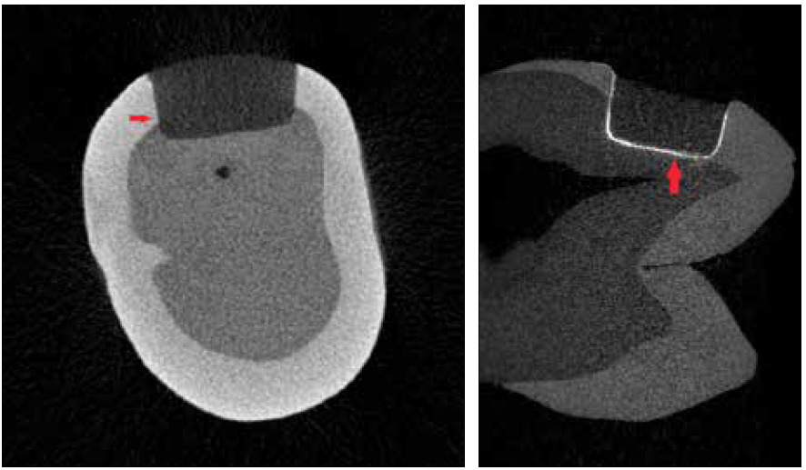 . Cross and axial sections showing dye penetration beyond half of the interface length-Score 2