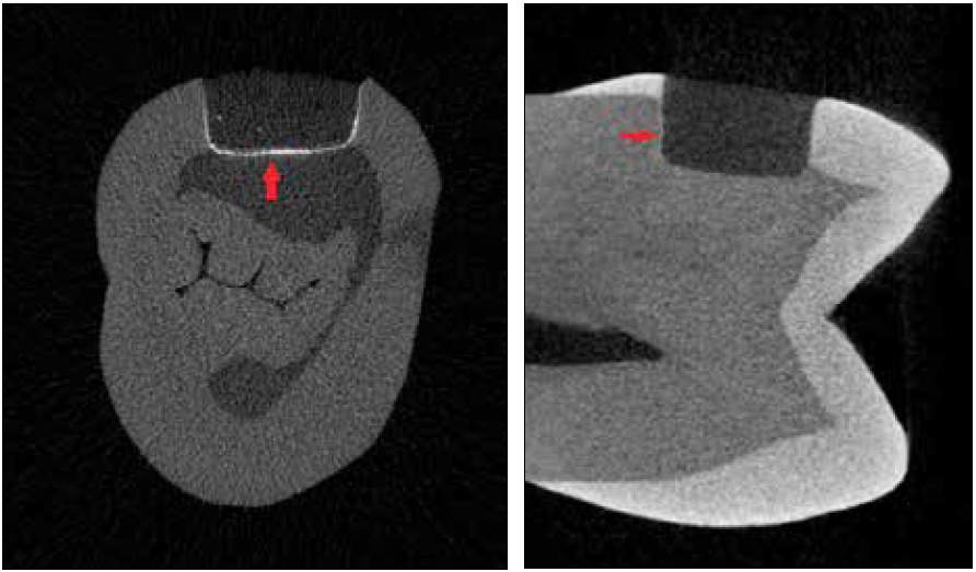 . Cross and axial sections showing dye penetration all around the sealant-Score 3
