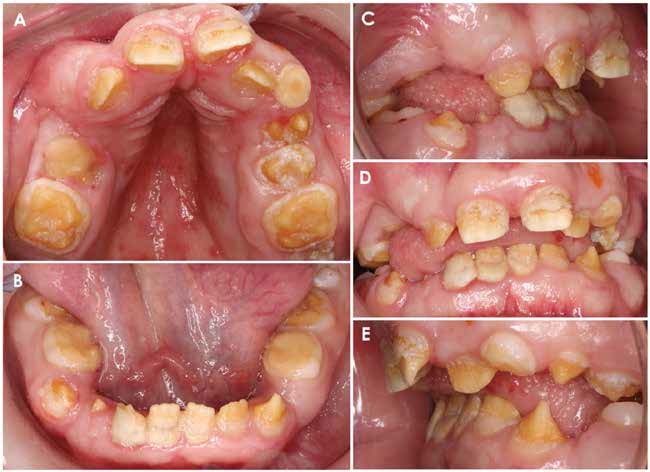 . Intraoral photographs of the patient, including maxillary occlusal (A), mandibular occlusal (B), right lateral (C), frontal (D)
and left lateral (E) views. Soft tissue findings include generalized marginal gingivitis, thick and fibrous attached gingiva and
scattered petechiae on the mucosa of the posterior hard and soft palate. While free from any carious lesions, the dental
hard structures demonstrate a generalized developmental defect (consistent with enamel hypomineralization and post
eruptive enamel breakdown), affecting both dentitions in a similar manner. Heavy plaque accumulation on all teeth and
substantial calculus deposits on the mandibular incisors are also evident.