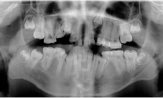 . Panoramic radiograph of the patient at the initial examination. The maxillary left, mandibular right and mandibular
left second premolars are congenitally missing. The forming second and third permanent molars demonstrate enamel
structure of appropriate radiopacity covering the entire crowns. In contrast, the developing maxillary right canine seem to
lack cuspal enamel.