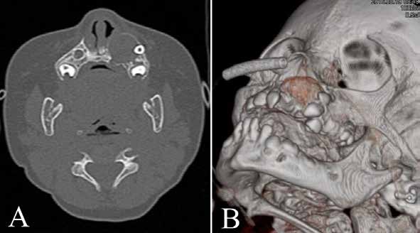 . TC aspects of the tumor. (A) Axial image showing a hypodense expansile mass in the left anterior
alveolar ridge of the maxilla, with aspects of thinning and rupture of the alveolar cortical bone. (B) 3D
view evidencing cortical bone thinning with rupture areas.