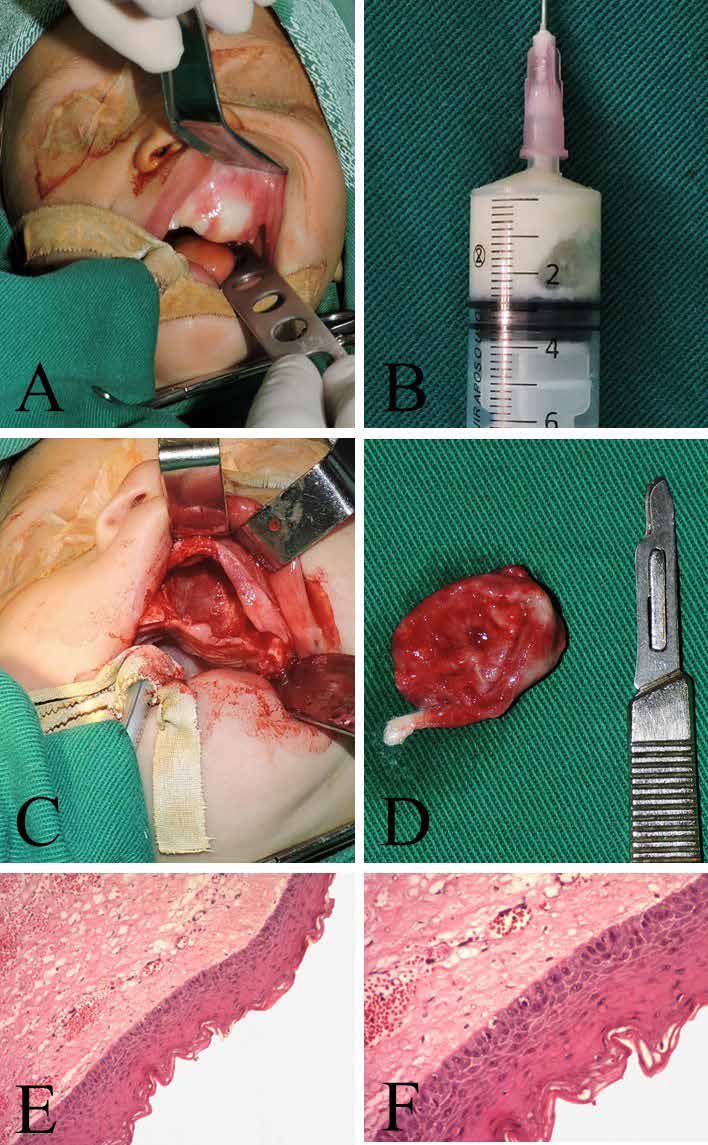 . Clinical aspects, transurgical procedures and histological aspects. (A) Lesion showing a
whitish to normal colored areas, located on the left side of the maxillary ridge. (B) Puncture of
the cyst demonstrating a creamy white suspension liquid. (C) Cystic cavity after enucleation.
(D) Lesion fragment measuring 20x20 mm. (E) Basal layer of the epithelium show columnar
cells with palisade morphology and hyperchromatic nuclei. The capsule of the lesion is
formed of loose connective tissue, with ectasic blood vessels and moderate mononuclear
inflammatory infiltrate. (F) The most superficial layer of the epithelium with corrugated keratin.