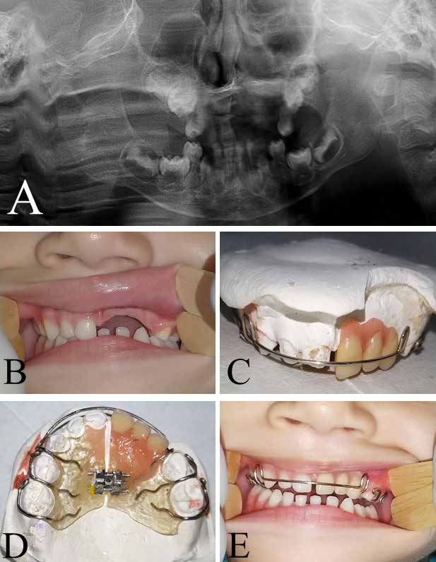 . Patient’s follow-up and rehabilitation. (A) Panoramic radiograph revealing a normal bone formation in
the affected area after 38-months follow-up. (B) Clinical aspect before rehabilitation. The patient had
the left maxillary central, lateral and canine missing. (C) Front view of the removable palatal expander
in the plaster model before the fit stage. (D) Palatal view of the removable palatal expander. (E) Final
aesthetical and functional result.