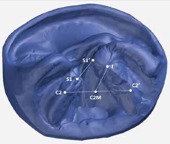 : Plaster model for UCLP with according distances.