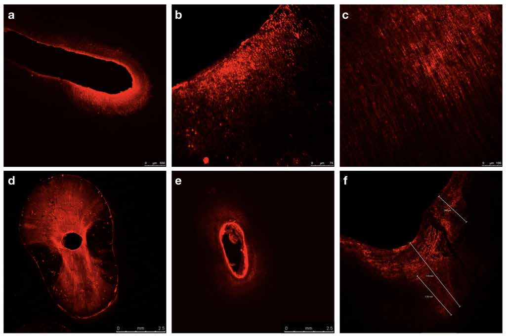 : onfocal laser scanning microscopy (CLSM) images of the different groups. Penetration of peroxide (red) inside the
dentinal tubules is clearly visible (a-f), in lower (a) and Higher (b,c) magnifcations. A butterfly-like appearance is seen on
the root cross section (d) that occurs as a result of increased sclerosis along the tubules located on the mesial and distal
sides of the canal lumen. Penetration depth was measured and recorded considering the canal wall as the starting point
(f). The peroxide penetration was significantly higher when the irrigation sequence consists of phosphoric acid prior the
bleaching agent placement (d) when comparing the other groups (a,e).
