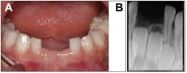 . (A) Intraoral image of follow up check. No clinical
signs on extraction site of #71, 81 area. (B) Periapical
radiograph showing no remarkable pathologic sign.