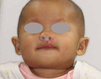 : Nasal creator device worn by patient with UCLP