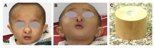 Using nasal creator device with kinesiology tape. A, Frontal view. B, Submentovertex view. C, kinesiology tape.