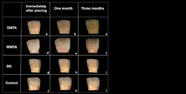 : In the figure, central permanent incisor, immediately after the medicament placement(a, d, g and j), one month after placing
(b, e, h and k) and three months after placing (c, f, I and l). Dark discoloration was visibly seen mainly in the GMTA group
after one month (b) and three months (c). discoloration was also visible in the WMTA group after 3 months (f). In the BD and
control group no visibly changes were noticed (g-i and j-l respectively).