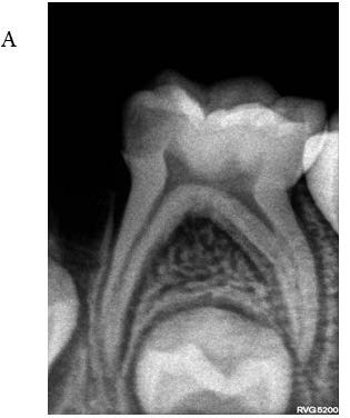 : Pre-operative radiograph of 75