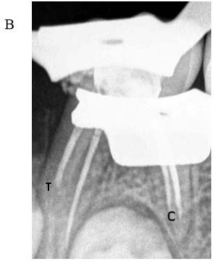 : Post obturation radiograph of 75 delineating
the outcome in test canal (T) and control canal (C)
respectively