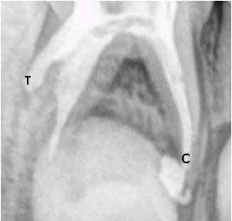 : Post obturation radiograph of 85 showing extrusion of
obturating material in control canal (C)