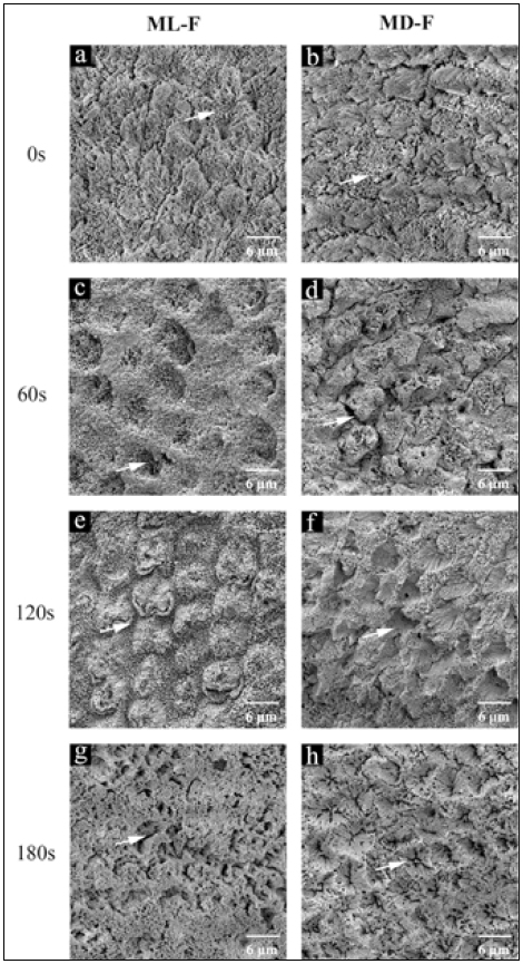: SEM images of various groups at a magnification
of ×5,000. (ML-F: mild fluorotic enamel, MD-F: moderate
fluorotic enamel). Mild and moderate fluorotic enamel
treated with 5.25%NaOCl for different treatment times
(0s, 60s, 120s, 180s).
Fig. a, b: Enamel rods and inter-rod substance with a nearly
uniform etching pattern but areas of hypomineralization of
enamel can also be observed (white arrow).
Fig. c, d, e and f: the inter-rod substances were removed and
both type I etching (in which the enamel rod, or prism,
head are dissolved) and type 2 etching (in which the enamel
interprismatic substance is dissolved) patterns are evident
(white arrow).
Fig. g, h: barely visible enamel rods and irregular etching
pattern were shown (white arrow).