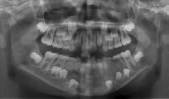 : radiographic finding, (March 2017, age 8).
The panoramic radiograph showed a well-defined unilocular
radiolucent area extending from the lingual aspect of 46 to the
other side of left molar region.