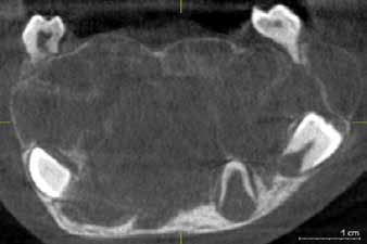 : coronal digital volume tomography of the oral cavity
(March 2017, age 8)
The permanent mandibular tooth germs 34, 35, 36, 44, 45, 46
were associated and already displaced on the lower border
of the mandible. The incisors were affected but not clinically
mobile.