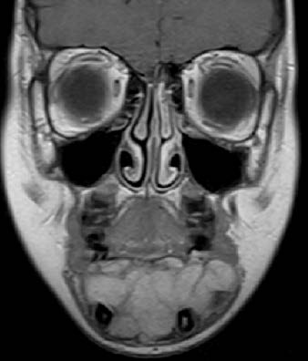 : coronal T1 magnetic resonance imaging (MRI) of the
face
MRI was carried out under general anesthesia. The MRI shows
a cyst-like radiolucent area with a well-defined margin. A typical
multilocular honeycomb appearance of the lesion can be seen.