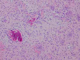 : Histopathology, H&amp; E staining
Central giant cell lesion destroying the mandibular bone.
The aggressive lesion is composed of osteoclast-like
multinucleated giant cells and mononuclear polygonal or
spindled cells set in a fibrovascular stroma. At the left side
remnants of the destroyed preexistent mandibular bone can be
seen. 100 μm