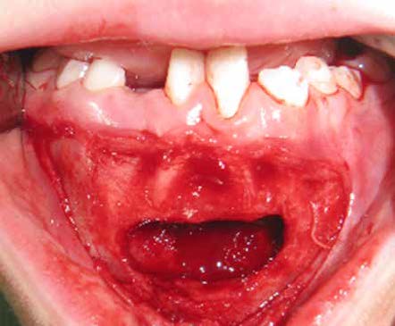 : Surgical approach
The intraoral approach was localized in the chin area, so that
the teeth germs remained undamaged. Therefore, a careful
curettage of the whole lesion could be performed.