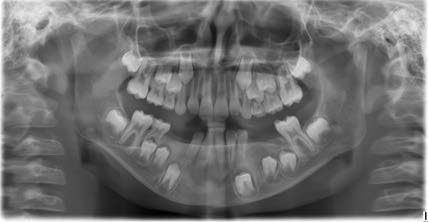: Follow- up radiographic examination, (November
2019, age 11)
Two years later, the dental germs 34, 35, 36, 44, 45, 46 appeared
ready to erupt spontaneously, with orthodontic treatment as
needed.