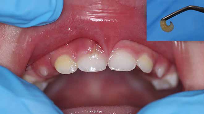 . The larva and the orifice from which it was removed from the gingiva.
