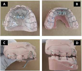 . Sander bite jumping appliance; A, Maxillary plate; B,
Mandibular plate; C, Lateral view of the elements long
16 mm; D, Lateral view showing how the two plates
interconnect with each other determining a mandibular
advancement