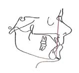 Effects of Orthodontic Functional Appliances in Relation to Skeletal Maturation of Cervical Vertebrae in Class II Malocclusion figure 4