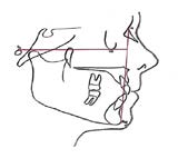 Effects of Orthodontic Functional Appliances in Relation to Skeletal Maturation of Cervical Vertebrae in Class II Malocclusion figure 5