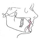 Effects of Orthodontic Functional Appliances in Relation to Skeletal Maturation of Cervical Vertebrae in Class II Malocclusion figure 6