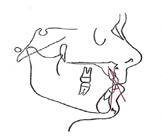 Effects of Orthodontic Functional Appliances in Relation to Skeletal Maturation of Cervical Vertebrae in Class II Malocclusion figure 7