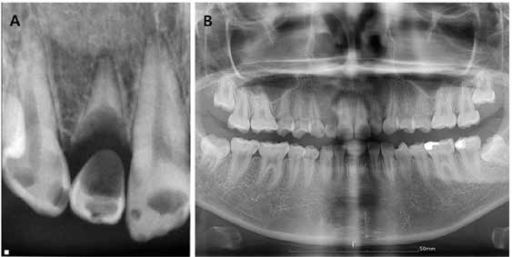 . (A) Periapical image of tooth #12 with progressed internal root resorption. (B) Panoramic image 4 years after the initial visit.