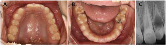 . (A) Intraoral image of both dentitions 3 month after #12 extraction. (B) Periapical image of #22.