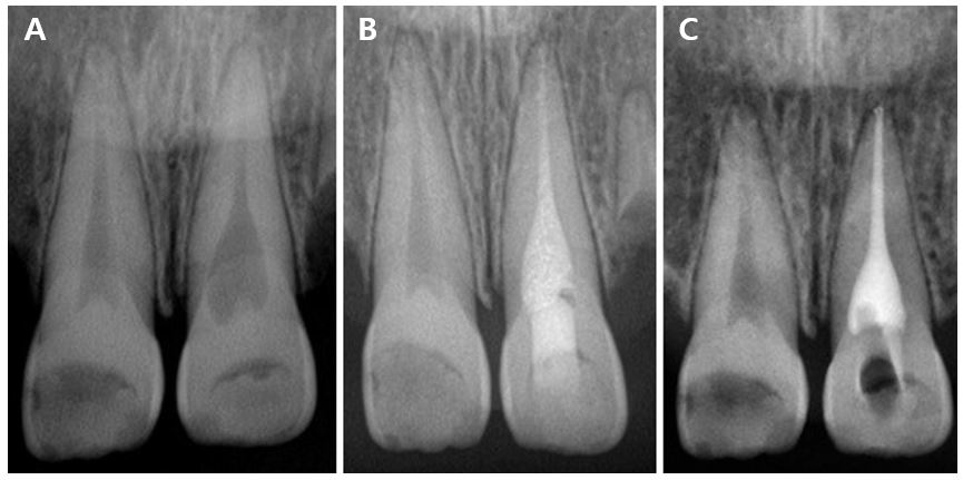 . (A) Before root canal treatment of #21. (B) During the treatment. (C) After the canal filling was completed.