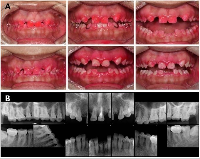 .  (A) Intraoral image after applying a disclosing agent, Improvement of oral hygiene after professional tooth cleaning and with patient education. (B) Full mouth periapical view at the latest follow-up, no remarkable pathologic findings are noted.