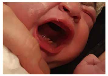 : Natal teeth (#71 and #81) observed right after birth.