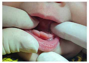 : Initial clinical presentation of two nodules on the
mandibular anterior region, pink and normal surface, 5
months after the removal of the natal teeth.