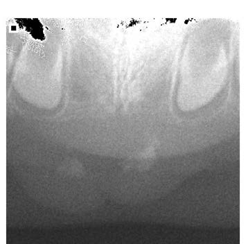 : Periapical radiograph showing radiopaque small
masses in the mandibular anterior region.