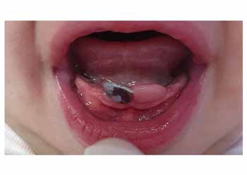 : Purple nodule located on the right side (region of tooth #81) and nodule located on the region of #71 with the same clinical aspect as observed in the first evaluation.