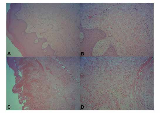 : HE-stained sections. 5A-B: Epithelial lining with areas of hyperplasia, acanthosis and
hyperkeratosis (x40). Deposition of collagen fibers and fibroblasts, areas of chronic
inflammation (x100). 5C-D: Epithelial lining with ulceration (x40). Fibrovascular
proliferation and chronic inflammatory cells (x100).
