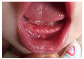 : Clinical presentation of the area on the 6th day after
the surgery a complete clinical healing.