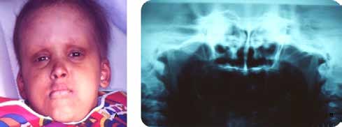 . (A) Patient`s facial aspect. (B) Panoramic x-ray showing absence of all teeth and tooth buds.
