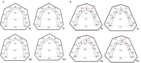 . (A) Maxilla diagnostic cast analysis at age of 3, 7, 12 and 21 years.
(B) Mandible diagnostic cast analysis at age of 3, 7, 12 and 21 years.