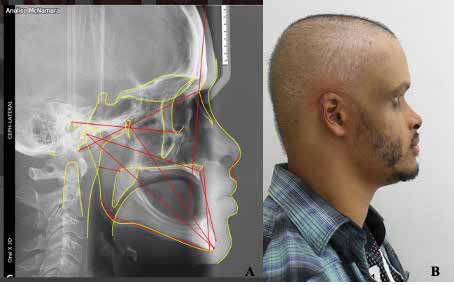 . (A) Craniofacial landmarks (McNamara Standards) used for cephalometric analysis at age of 21 years.
(B) Patient`s facial profile using the last set of complete dentures at age of 21 years.