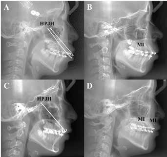 . Lateral cephalograms using high-pull J-hook headgear
(HPJH) and mini-implants (MIs): A and B, canine
retraction with HPJH and MIs; C and D, anterior tooth
retraction with HPJH and MIs.