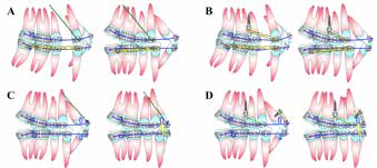 . Schematic diagrams of treatment protocol with highpull
J-hook (HPJH) and mini-implants (MIs): A and B,
leveling and canine retraction with HPJH and MIs; C
and D, en masse anterior tooth retraction with HPJH
and MIs.
