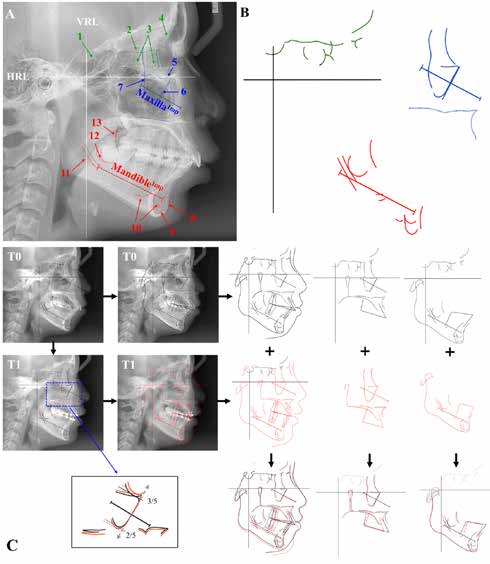 . Structural superimposition
method. A. Stable structures,
vertical and horizontal
references lines (VRL and HRL),
and implant lines (MaxillaImp,
and MandibleImp). Anterior
cranial base is indicated in
green: 1. anterior wall of the
sella turcica, 2. cribriform
plate, 3. ethmoidal cell walls,
4. cerebral surface of the
squamous part of the frontal
bone. Maxilla is indicated in
blue: 5. orbital floor, 6. anterior
border of the zygomatic bone
including the lower rim of the
orbit and the key ridge, 7. the
anterior surface of the temporal
fossa. Mandible is indicated in
red: 8. anterior contour of the
symphysis, 2 to 3 mm down
from point B to pogonion, 9.
endosteal inner contour of the
symphysis, 10. any trabecular
pattern inside the symphysis
or the corpus that is visible
in all films, 11. mandibular
canal, 12. fundus of the crypt
of the third molar, 13. anterior
contour of the coronoid process
(secondary guideline, this
contour was not a reference
marker, but it did provide an
extra control: With growth, this
contour moves in a posterior
direction, never forward). B.
Template of anterior cranial
base, maxilla, and mandible.
C. Workflow of tracing and
superimpositions.