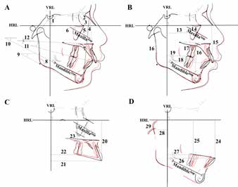 . Cephalometric measurements. Structural
superimposition on the cranial base (A and B), maxilla
(C), and mandible (D) (Table 2).