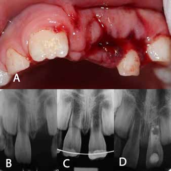 (A) Avulsion of tooth no:21 and lateral luxation of
tooth no:62, (B) initial periapical radiograph of the
empty socket of tooth no:21, (C) periapical radiograph
of the replanted tooth confirming the correct position
of the replanted tooth no:21, (D) periapical radiograph
after MTA placement over the blood clot